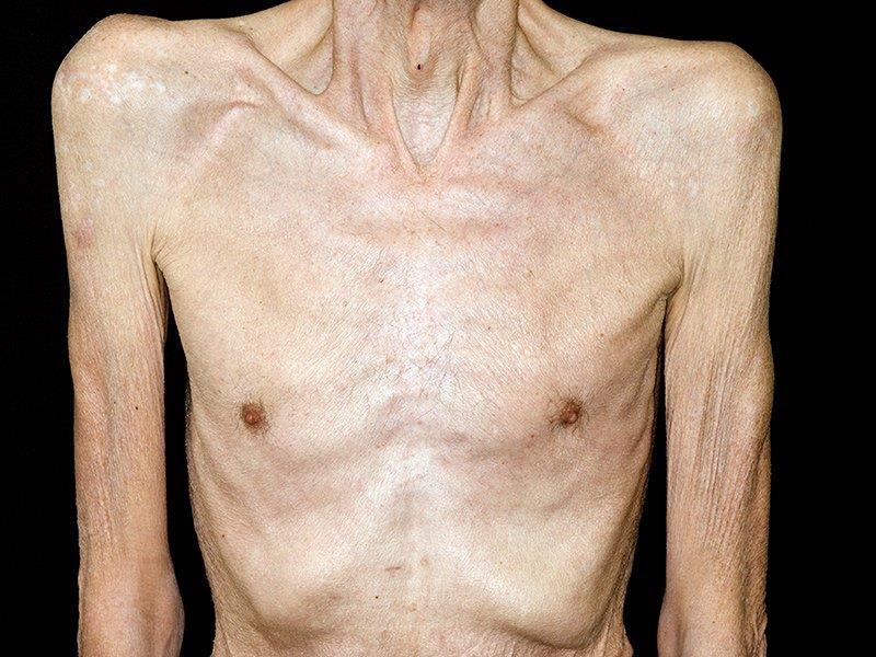 Cancer cachexia = progressive loss of body fat and lean body mass, accompanied by profound weakness, anorexia, and anemia not