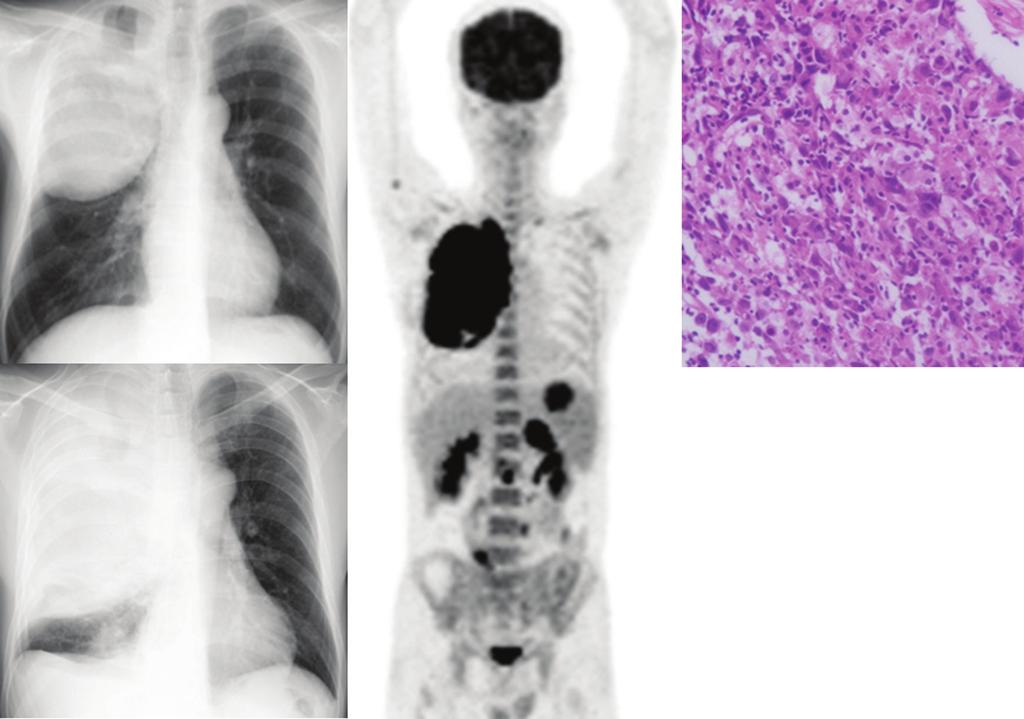 Koh H, et al. (C) (D) Fig. 1 Chest X-ray obtained on admission demonstrated a large mass in the right lung field.