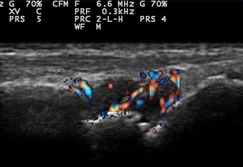 216 Bulletin of the NYU Hospital for Joint Diseases 2011;69(3):215-9 Figure 1 Ultrasound gray-scale image of the dorsal wrist, longitudinal view.