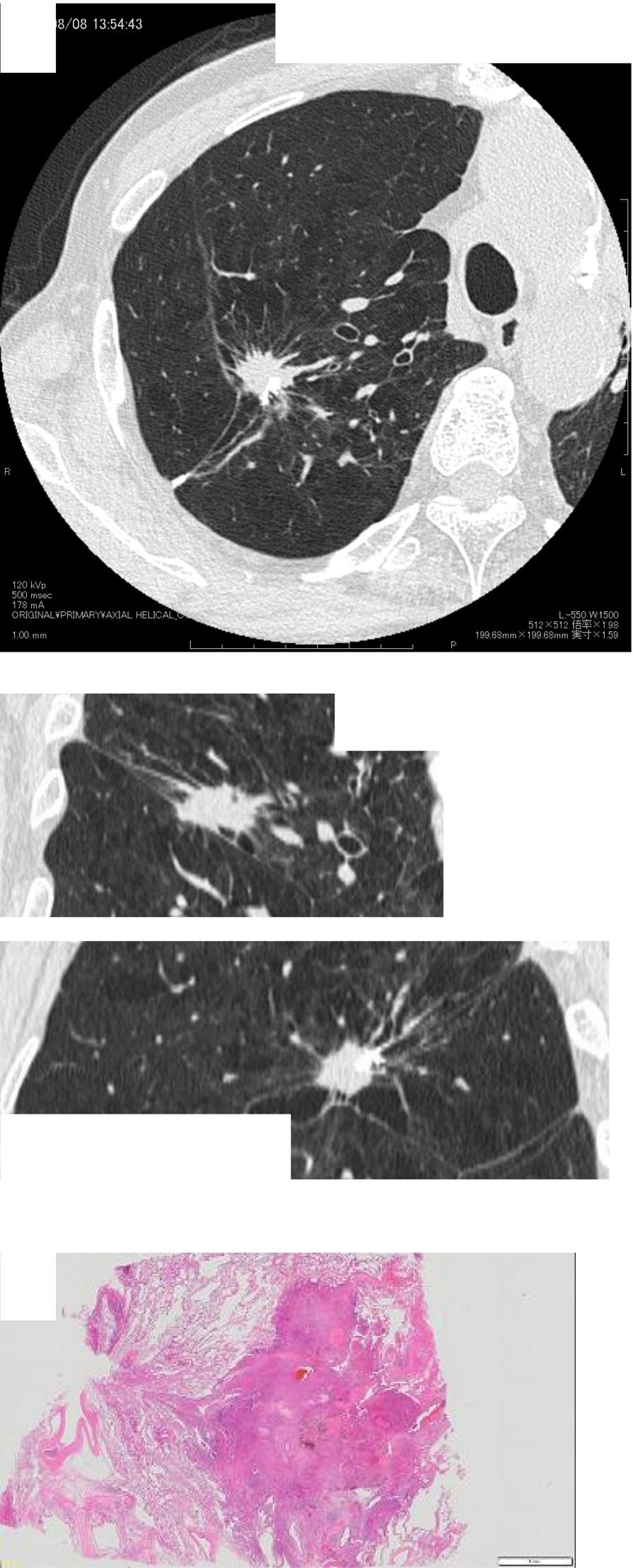 Hanaoka et al. Surgical Case Reports (2018) 4:2 Page 5 of 7 a b Fig. 5 a Radiographic estimation by multi-planar reconstructions (transverse, coronal, and sagittal views) on thin-slice CT images (0.