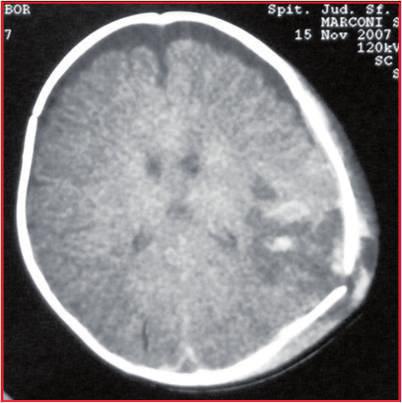 are observed strictly in the immediate postnatal period. Cephalhaematoma is a posttraumatic hemorrhage (a collection of blood) located sub periosteal.