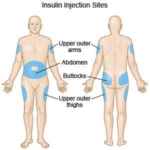 INJECTING INSULIN INSERT NEEDLE AT A 90º ANGLE (45º FOR VERY THIN) DEPRESS PLUNGER HOLD FOR 5 SECONDS WITHDRAW NEEDLE DISPOSE IN