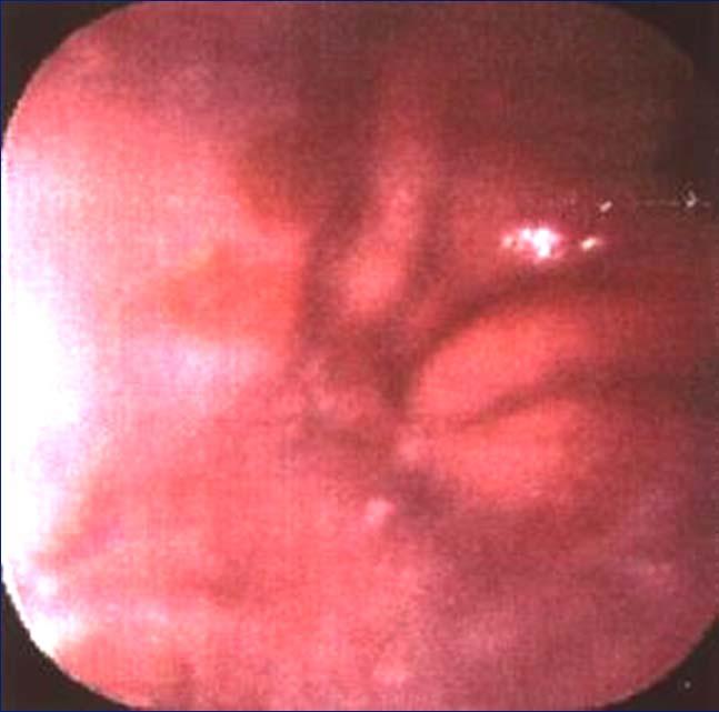 #2: Obese adult male Heartburn for 20 years, recently worse Not responding to PPIs endoscopy GEJ tongues: cannot tell if this is an exaggerated