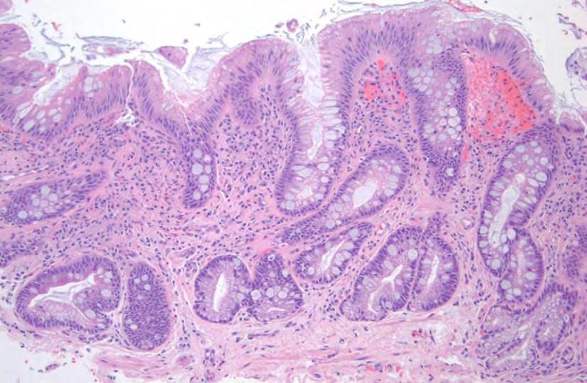Goblet cells in columnar mucosa Typical