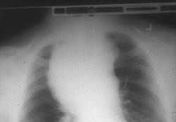 Pneumonia airway obstruction 5.