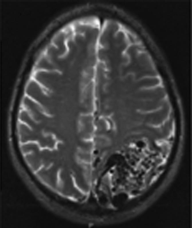the anterior and posterior cerebral arteries. C: Axial T2-weighted MRI scan demonstrating multiple flow voids within the AVM. AVM: arteriovenous malformation.