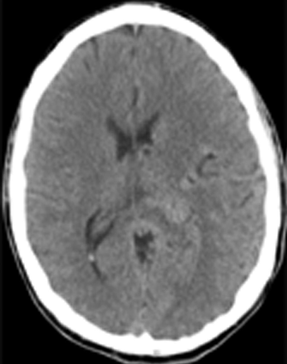 A repeat head CT scan on the second day of hospitalization demonstrated stable IVH without ventriculomegaly. The patient was then transferred from the ICU to the neurosurgical ward for observation.