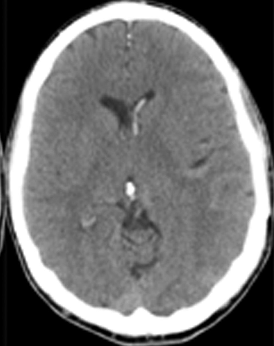 An urgent CT scan revealed the interval development of hydrocephalus, with the suggestion that a portion of the intraventricular thrombus had migrated from the left lateral ventricle to the junction