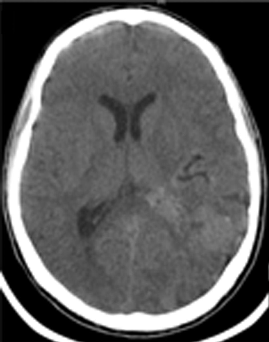 Acute Transient Hydrocephalus after IVH A B Fig. 3.