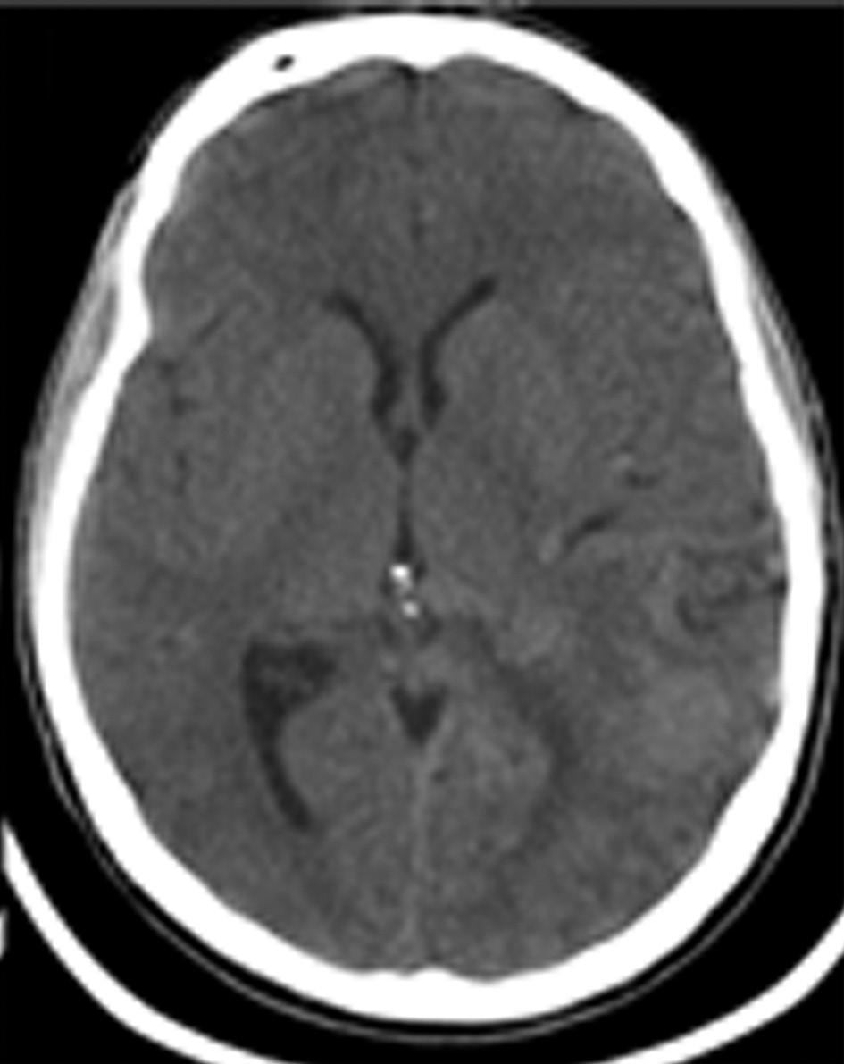 left lateral ventricle to the junction of the third ventricle and cerebral aqueduct. A B Fig. 4.