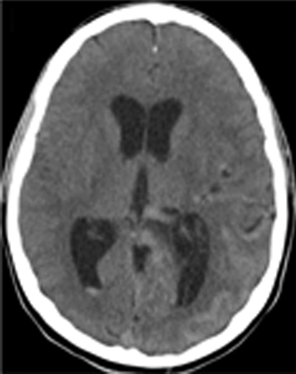 Discussion Obstructive hydrocephalus is common after IVH due to obstruction of normal CSF flow and absorption by the thrombus.