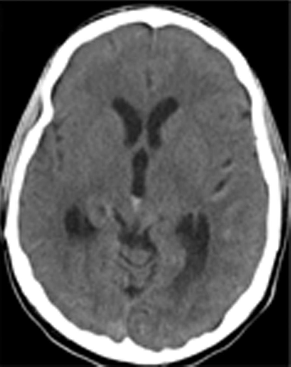 shunting. A delayed development of acute but transient obstructive hydrocephalus is unusual in this patient population.