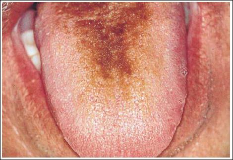 Throat Tongue (lesion, movement)