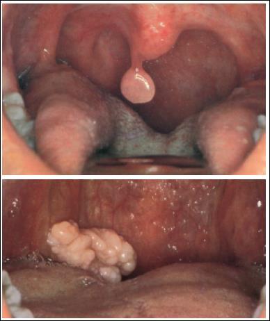 parapharynx) Uvula & Palate