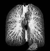 Diagnosing lung cancer Courtesy of Wiemker et al.