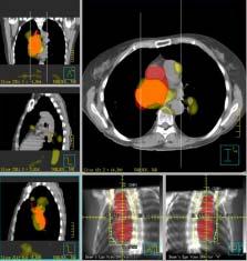 Philips trackrecord of continuous improvements in Nuclear Medicine