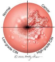 Cancerul de col uterin omoara in conditiile in care se ajunge tarziu la medic.