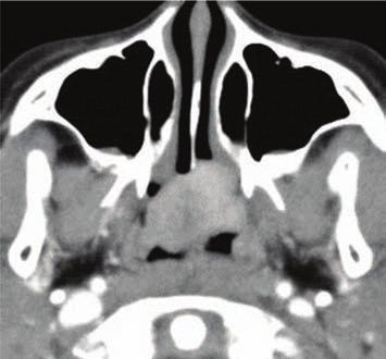 2 Case Reports in Otolaryngology Figure 1: Axial and coronal computed tomography scans with contrast medium showing a soft tissue mass in the nasopharynx with homogeneous enhancement (arrows). 3.