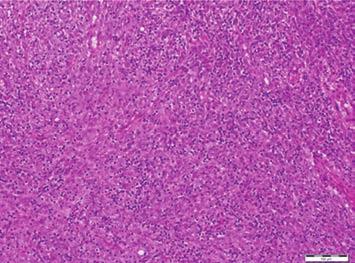 Immunohistochemical staining showing diffuse cytoplasmic reactivity for ALK (c). SMA (95.