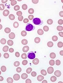 Clinical context Cytopenia (Neutropenia, anemia) Splenomegaly Lymphocytosis Autoimmune conditions (e.g. RA) Modified from: 1.