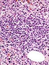 T-LGL Leukemia CD8 Reactive lymphoid aggregate (CD8-, CD4+) CD4 Morphologic features of T-LGL leukemia