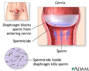 Diaphragm Also called Cervical Cap Requires a