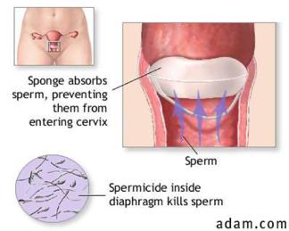 Sponge The sponge is inserted into the vagina and covers the cervix blocking sperm from entering the cervix.