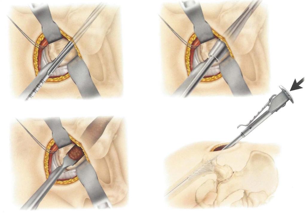 Surgical Technique In-line reaming of femoral canal.