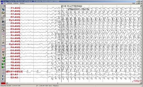 (more GTC, easy to control) 8 year old with staring spells Juvenile Absence Epilepsy (JAE) 9 yo girl with staring spells and new onset generalized convulsions. Described recently 1980s?