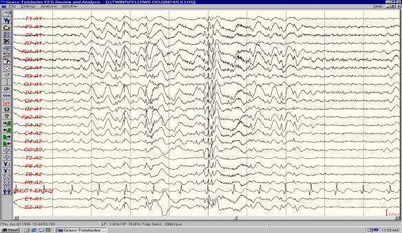 atonic, atypical absence, GTC, MYO EEG: - Interictal: slow S/W ( < 3 cps), GPFA during sleep