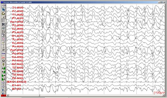 control Polyspike and atypical spike wave 48 yo woman with Lennox-Gastaut syndrome.