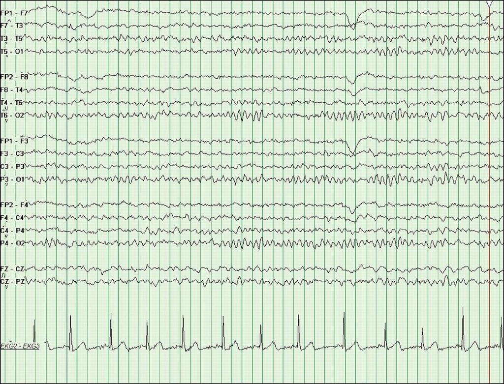 Normal EEG tracing showing a reactive posterior alpha (9-Hz) rhythm in an 8-year-old
