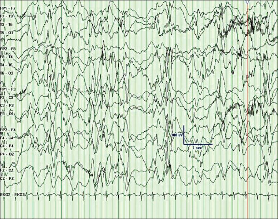 EEG showing hypsarrhythmia in a 9-month-old girl who has