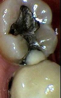 Case and Case Management Case 1 Male, 50 years old, present with throbbing pain when eating on the lower right back teeth since 2 days ago.