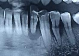 A final diagnosis of Generalized Chronic Periodontitis with severe bone loss on the mandible was established.