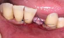 vertical flap incision on 5 mm apically from the margin gingiva of Figure