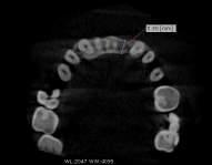98 mm (CBCT evaluation, axial) Figure 29. The width of alveolar bone is 5.