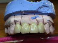 All-zirconia crown and bridge on working cast One week after temporary crown and bridge insertion, the patient called back to perform the cementation of all zirconia crown and bridge (Figure