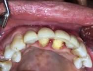 The heat-curedacrylic resin which is for removable partial denture was mounted