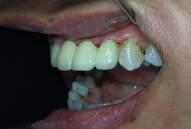 In order to solve her problem, we recommended the use of fixed partial denture