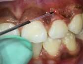 in intraoral examination found gingivsl hyperpigmentation in upper and lower. There was no marginal gingival inflamation.