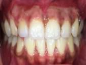 periodontal dressing