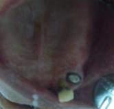Endodontic treatment 23 2.