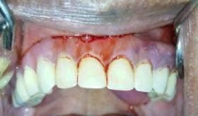 One week after denture was inserted and