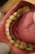 partial denture DISCUSSION The patient s demand of aesthetic and stable