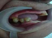 Pict 3. Right side intra oral examination Pict 4.
