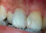 BACKGROUND Apex resection is a form of periapical surgery that most performed and most common.