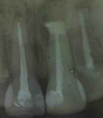 cavity with radiopaque appearance.