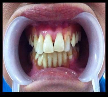 functional, stability and retention of the denture. CASE A 66 years old female, who had few teeth with a chief complaint in aesthetic aspect and difficulty of chewing.