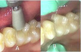 caries, or fracture.